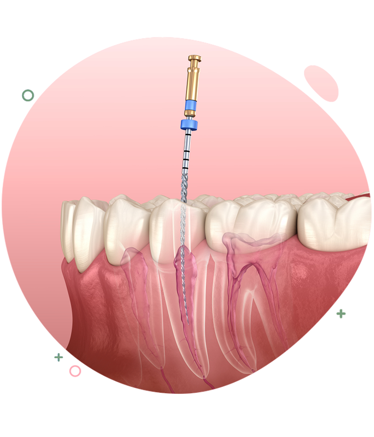 https://dentripalbania.com/wp-content/uploads/2023/05/Dentrip-web-Services-What-is-endodontics.png