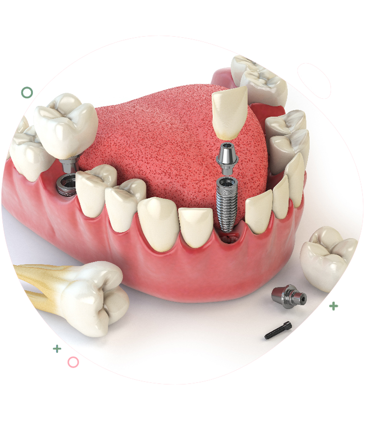 https://dentripalbania.com/wp-content/uploads/2023/05/Dentrip-web-Services-a-dental-implant-made-up-of.png