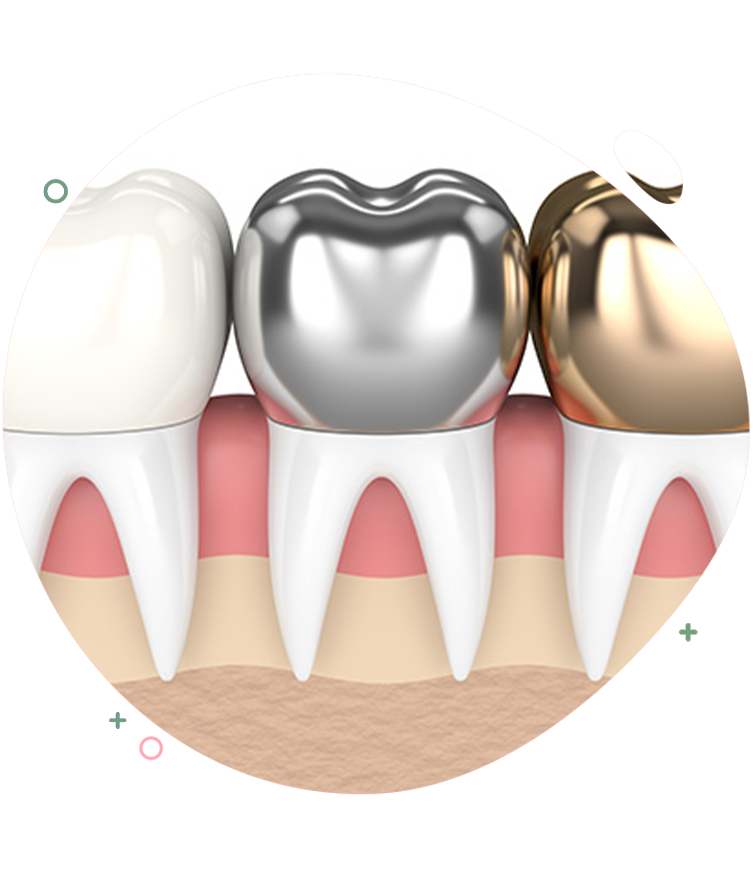 https://dentripalbania.com/wp-content/uploads/2023/05/Dentrip-web-Services-dental-crowns.png